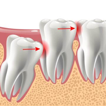 realistic 3D teeth, and wisdom tooth problems, oral anatomy