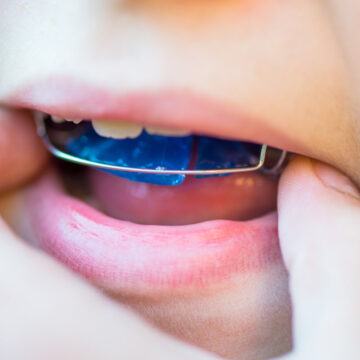 Boy Removes his Dental Blue Removable Brace or Retainer for Teeth from the Mouth, Orthodontic concept