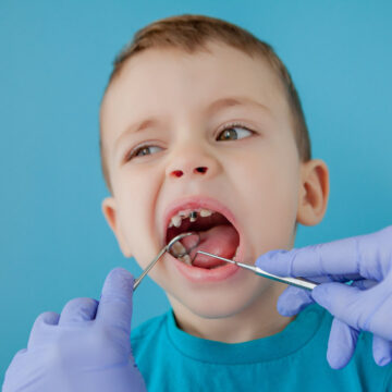 Close up of dentist's hands with assistant in blue gloves are treating teeth to a child, patient's face is closed